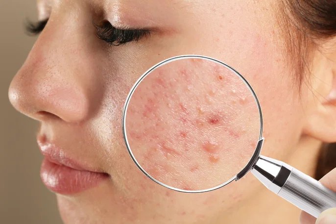 Lupa sobre a pele do rosto com acne, representando o tratamento de acne